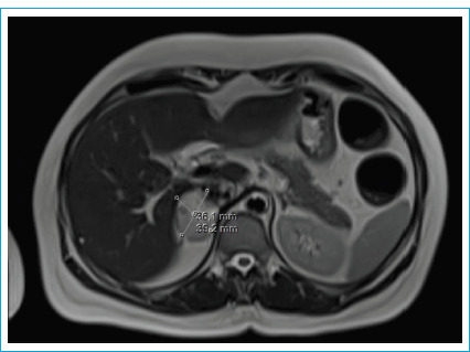 Surgical Management of Acute Appendicitis in a Patient with Diagnosed but "Unprepared" Pheochromocytoma: A Case Report.