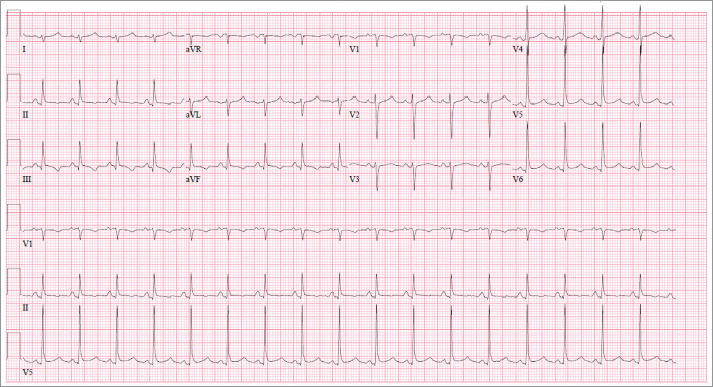 Cardiac Tamponade Secondary to Esophagopericardial Fistula.