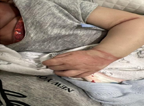 Overcoming the Challenges of Intravenous Immunoglobulin Resistance in Kawasaki Disease: A Case Report.