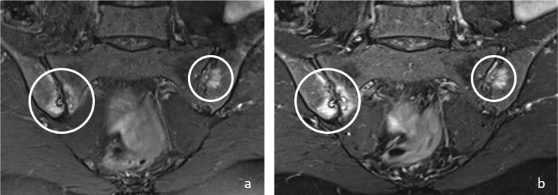 Can T1W and T2W Dixon Sequences Replace the Standard MRI Protocol in Diagnosing Sacroiliitis?