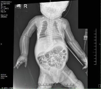 Demineralization of Osseous Structures as Presentation of a Rare Genetic Disorder That Is Associated With a High Rate of Mortality.