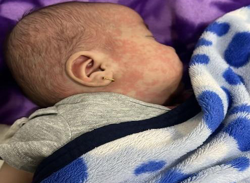Overcoming the Challenges of Intravenous Immunoglobulin Resistance in Kawasaki Disease: A Case Report.