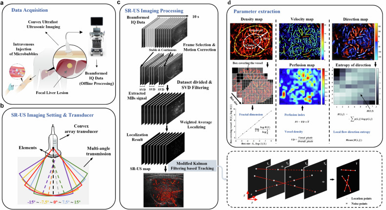 Focal liver lesions: multiparametric microvasculature characterization via super-resolution ultrasound imaging.