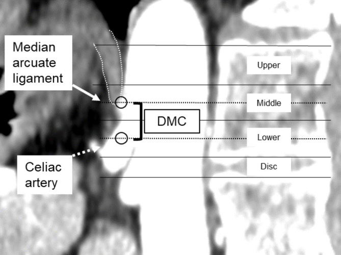 Quantitative Assessment of Celiac and Superior Mesenteric Artery Diameters in Adult Spinal Deformity Surgery Using Three-dimensional Computed Tomography.