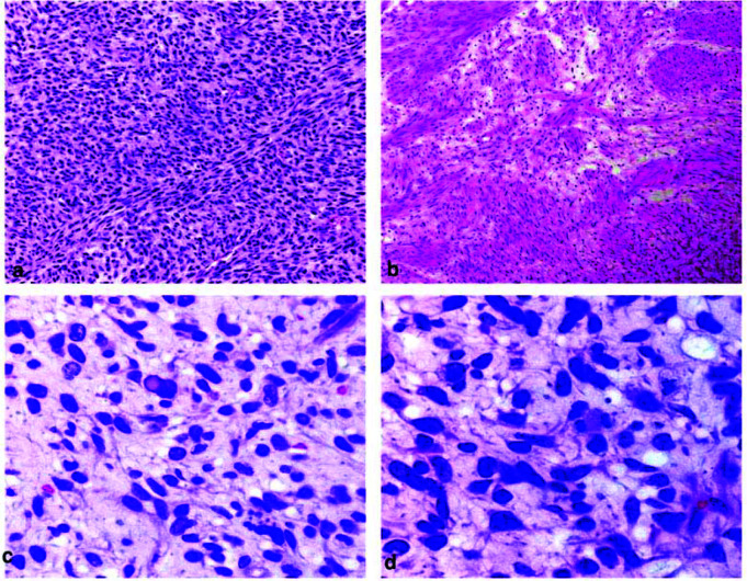 Cellular Schwannoma of the Palate Simulating as Malignant Peripheral Nerve Sheath Tumor: A Diagnostic Marathon.