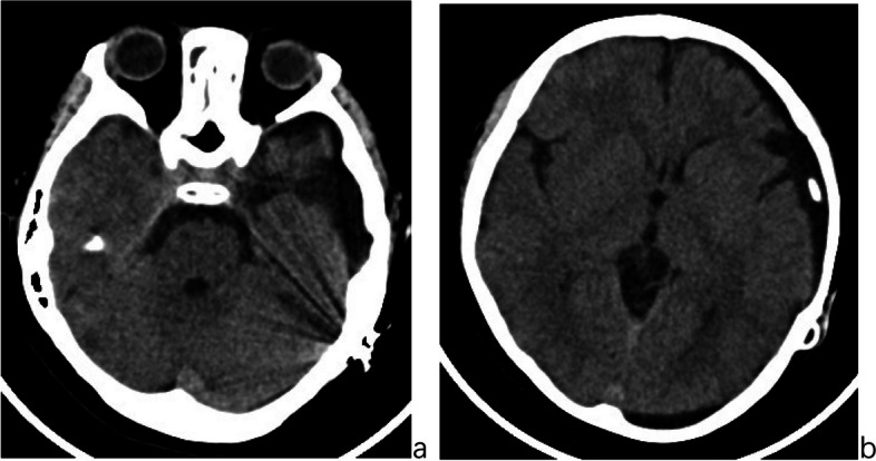 Nonadjustable state of programmable shunt valve: obstruction of middle cranial fossa arachnoid cyst-peritoneal shunt.