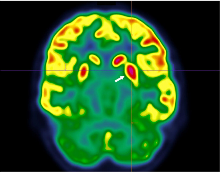 Case Report: Utility of brain [<sup>18</sup>F]FDG PET/CT in the diagnosis of Sydenham's chorea.