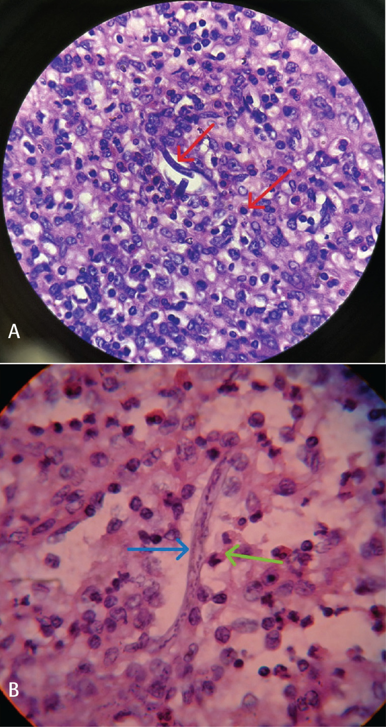 Unexpected Discoveries: Eosinophilia Masking Splenic Microfilariasis in a Young Woman