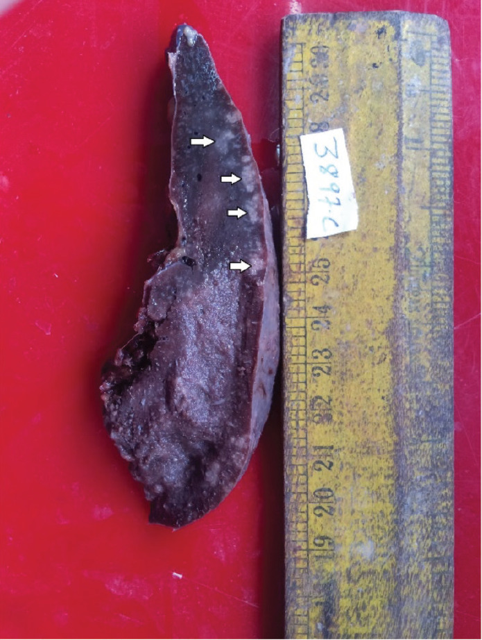 Unexpected Discoveries: Eosinophilia Masking Splenic Microfilariasis in a Young Woman
