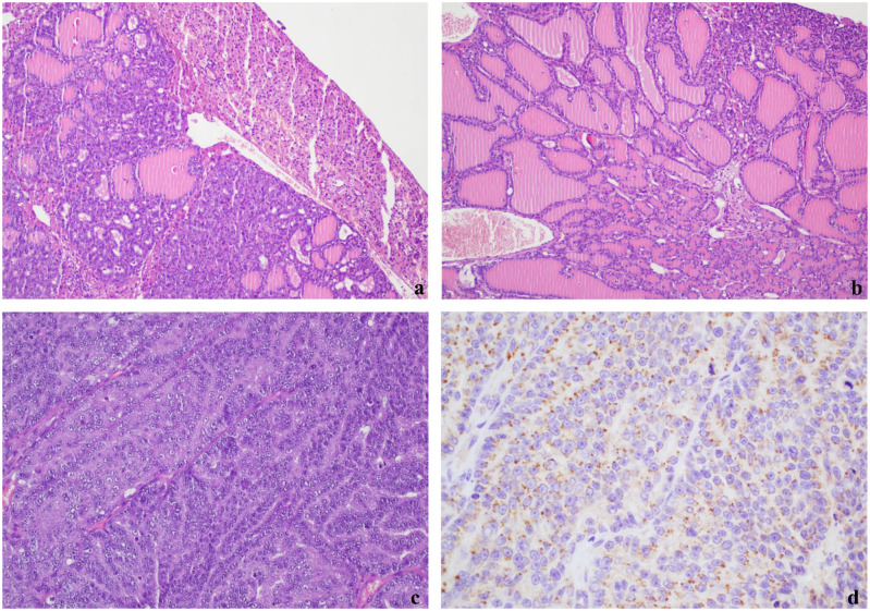 Adenocarcinoma originating from presumed liver ectopic thyroid in a cat.