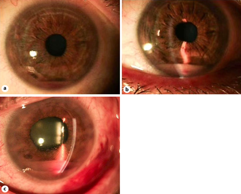 Candy Cane Hypopyon Secondary to Intraocular Mantle Cell Lymphoma: A Case Report.