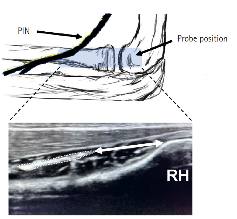 In vivo dynamic migration of the posterior interosseous nerve across various elbow and forearm positions.