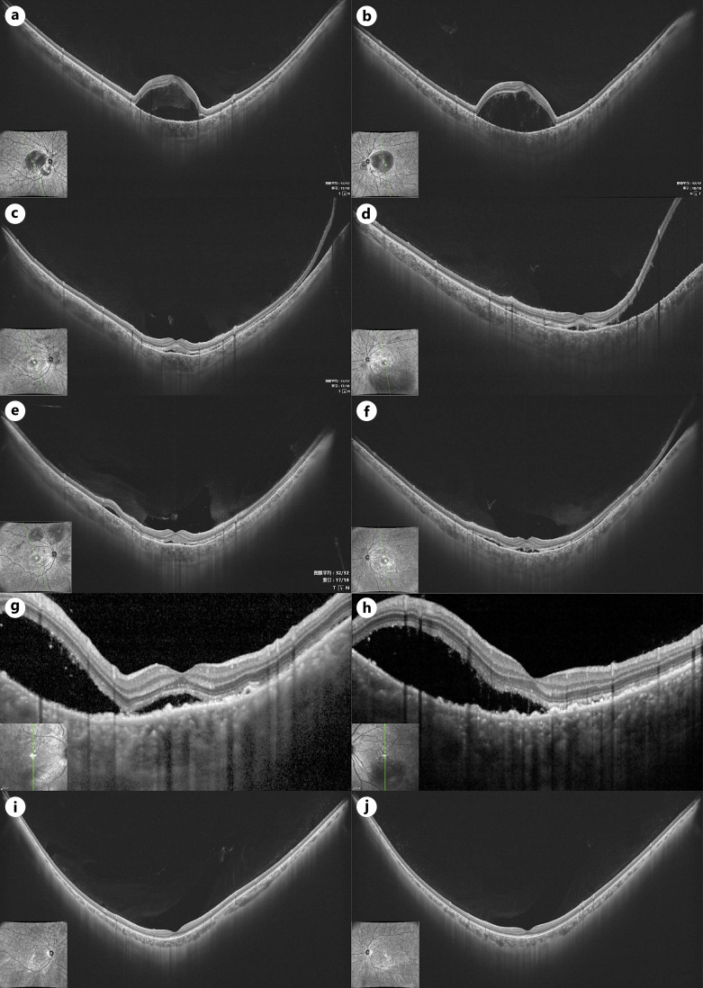 Bilateral Serous Retinal Detachment as an Initial Manifestation of Systemic Lupus Erythematosus due to Hypoalbuminemia: A Case Report.
