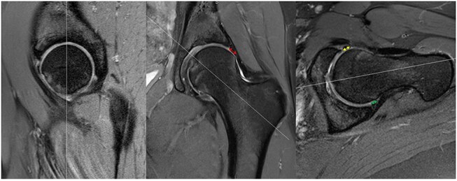 Labral size measured on preoperative magnetic resonance imaging not predictive of the need for labral reconstruction in patients undergoing primary hip arthroscopy.