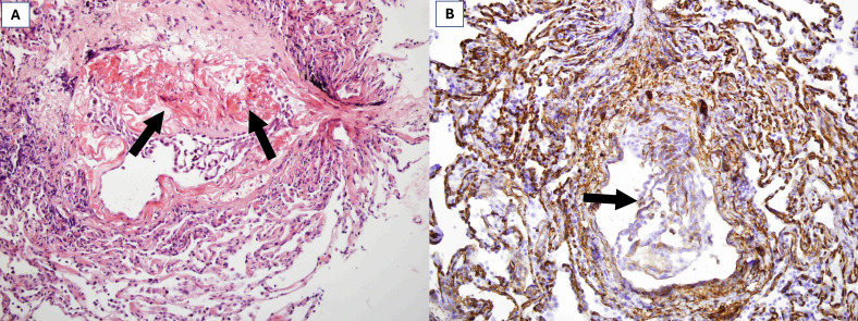 Lung long distance: histopathological changes in lung tissue after COVID-19 pneumonia.