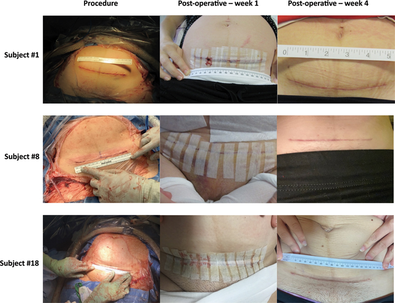 Corrigendum: The Collection and Application of Autologous Amniotic Fluid to Cesarean Delivery Closure.