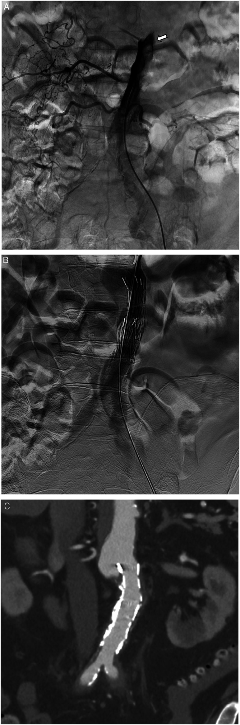 Endovascular stent graft treatment for stenosis in isolated infrarenal abdominal aortic dissection: A case report.