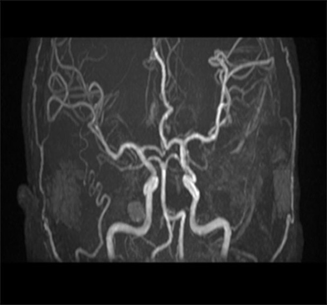 Intracerebral Hemorrhage with Churg Strauss-Syndrome: Multidisciplinary Collaboration and Literature Review.