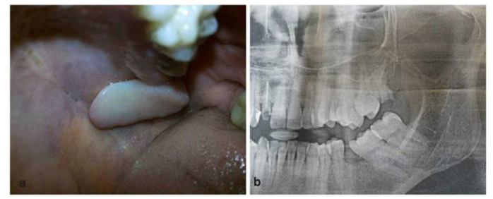 Cellular Schwannoma of the Palate Simulating as Malignant Peripheral Nerve Sheath Tumor: A Diagnostic Marathon.