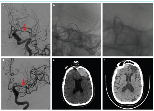 Endovascular Treatment in Symptomatic Intracranial Artery Stenosis: Experience from Two Centers.