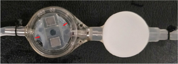 Nonadjustable state of programmable shunt valve: obstruction of middle cranial fossa arachnoid cyst-peritoneal shunt.