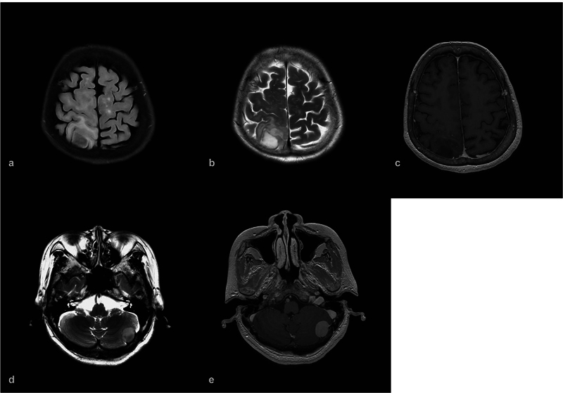 A Rare Case of Dual Primary Supratentorial Glioma and Infratentorial Meningioma.