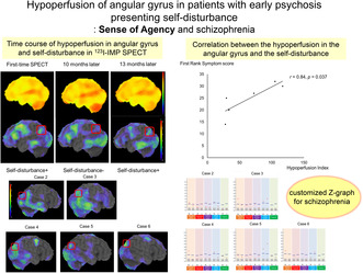 Case series of patients with early psychosis presenting hypoperfusion in angular gyrus and self-disturbance: Implication for the sense of agency and schizophrenia.