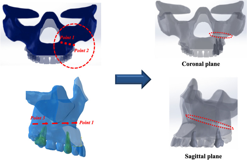 Biomechanical stability of magnesium plate and screw fixation systems in LeFort I osteotomy: a three-dimensional finite element analysis.