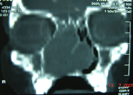 A cellular schwannoma of the nasal septum: a case report.