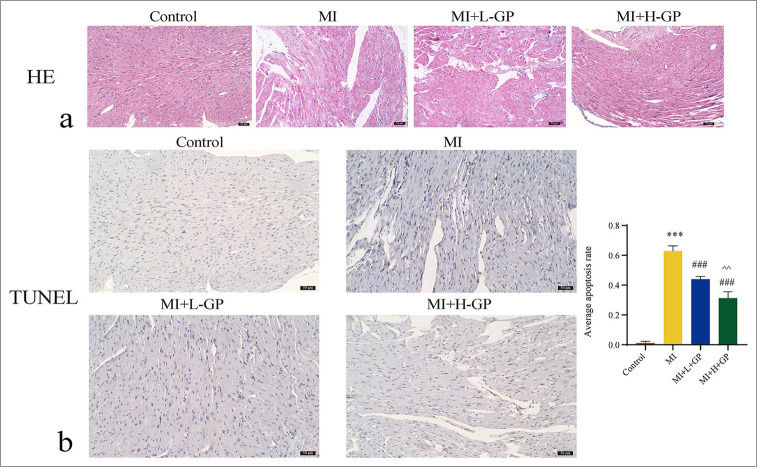 Geniposide alleviates post-myocardial infarction-induced pyroptosis by modulating the thioredoxin-interacting protein/NLRP3 signaling pathway.