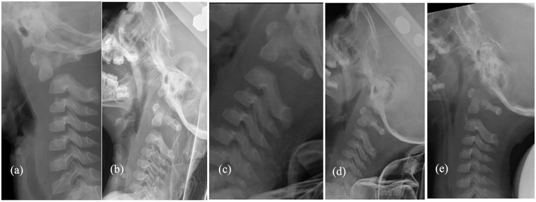 Conservative treatment for traumatic atlantoaxial joint infra-anterior dislocation complicating odontoid fracture in young children: A case series.