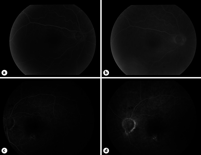 Candy Cane Hypopyon Secondary to Intraocular Mantle Cell Lymphoma: A Case Report.