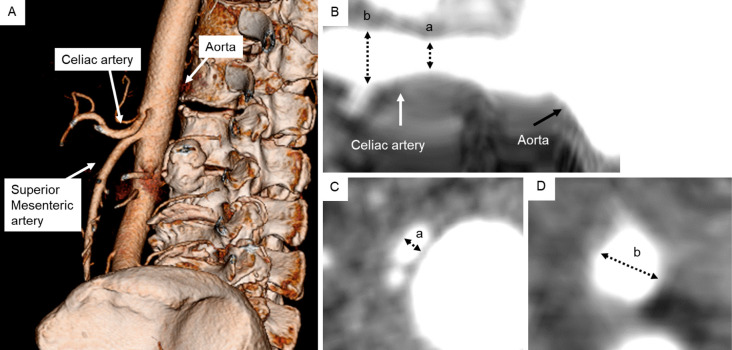 Quantitative Assessment of Celiac and Superior Mesenteric Artery Diameters in Adult Spinal Deformity Surgery Using Three-dimensional Computed Tomography.