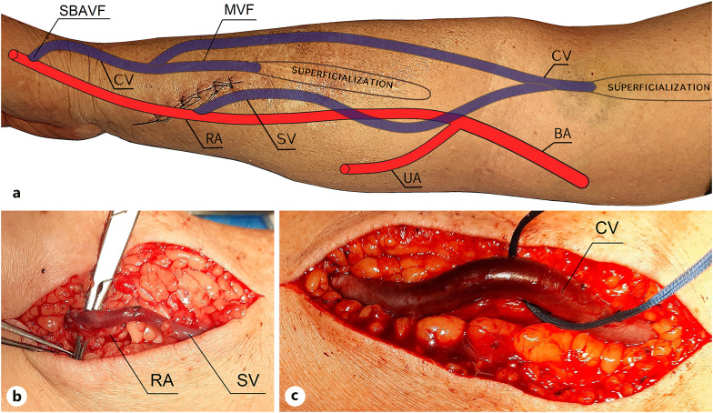 The Forearm's Subcutaneous Venous Network to Accelerate Maturation of Native Arteriovenous Fistula: A Case Report.