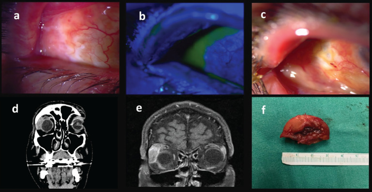 Management of Orbital Granulomatous Polyangiitis Presenting with Lacrimal Gland Involvement: Treatment of Subsequent Peripheral Ulcerative Keratitis, Anterior Uveitis, and Exudative Retinal Detachment in a Challenging Case.