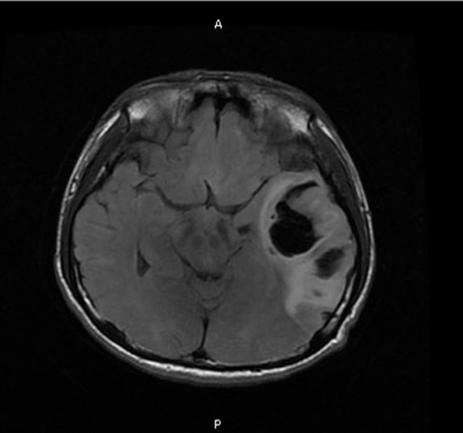 Intracerebral Hemorrhage with Churg Strauss-Syndrome: Multidisciplinary Collaboration and Literature Review.