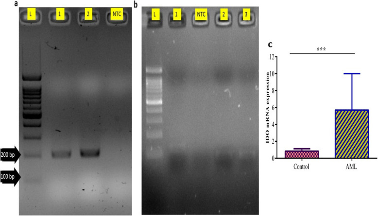 Increased IDO expression and regulatory T cells in acute myeloid leukemia: implications for immune escape and therapeutic targeting.