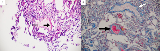 Lung long distance: histopathological changes in lung tissue after COVID-19 pneumonia.