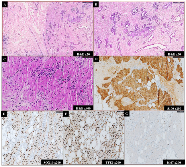Unveiling Rare Breast Neoplasms: Diagnostic Challenges and Insights.