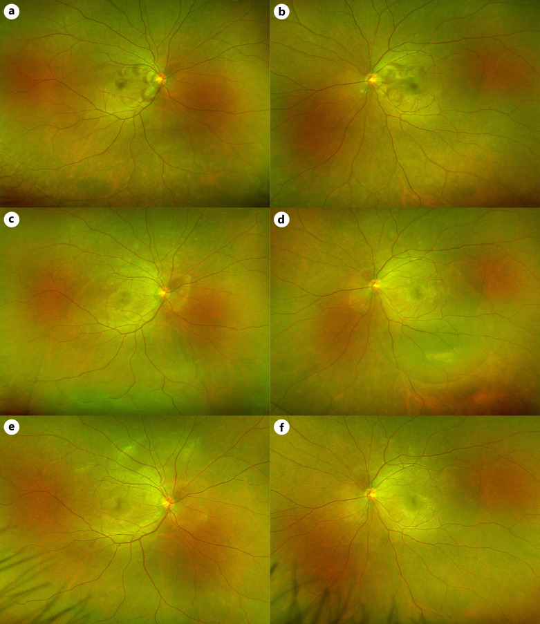 Bilateral Serous Retinal Detachment as an Initial Manifestation of Systemic Lupus Erythematosus due to Hypoalbuminemia: A Case Report.