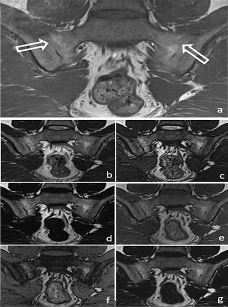Can T1W and T2W Dixon Sequences Replace the Standard MRI Protocol in Diagnosing Sacroiliitis?