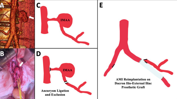 Repair of multiple abdominopelvic aneurysms: is the open approach still valid? A case report.