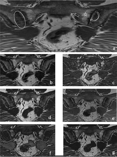 Can T1W and T2W Dixon Sequences Replace the Standard MRI Protocol in Diagnosing Sacroiliitis?