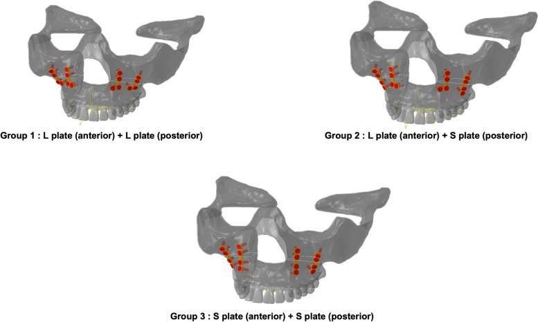 Biomechanical stability of magnesium plate and screw fixation systems in LeFort I osteotomy: a three-dimensional finite element analysis.