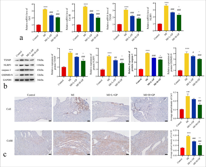 Geniposide alleviates post-myocardial infarction-induced pyroptosis by modulating the thioredoxin-interacting protein/NLRP3 signaling pathway.