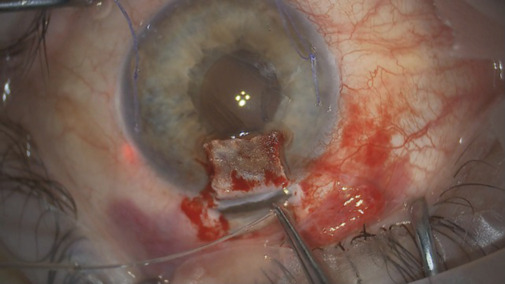 Ab externo Schlemm's canal surgery: Efficacy and safety outcomes.
