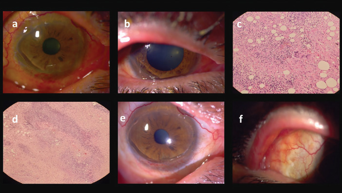 Management of Orbital Granulomatous Polyangiitis Presenting with Lacrimal Gland Involvement: Treatment of Subsequent Peripheral Ulcerative Keratitis, Anterior Uveitis, and Exudative Retinal Detachment in a Challenging Case.