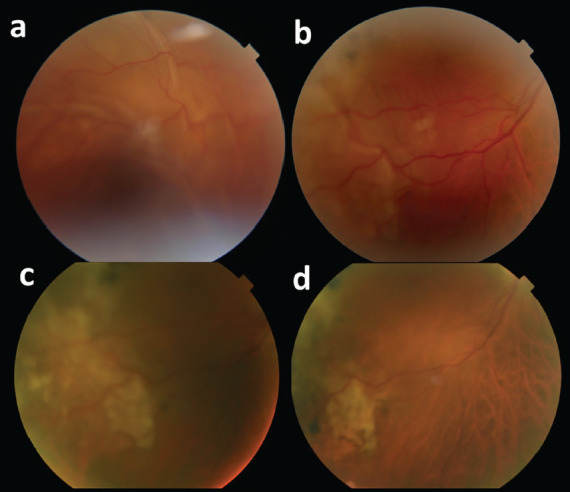 Management of Orbital Granulomatous Polyangiitis Presenting with Lacrimal Gland Involvement: Treatment of Subsequent Peripheral Ulcerative Keratitis, Anterior Uveitis, and Exudative Retinal Detachment in a Challenging Case.