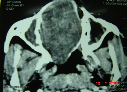 A cellular schwannoma of the nasal septum: a case report.