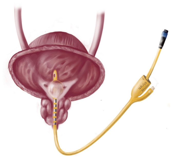 A Comparative Study on the Clinical Outcomes of Bipolar Radiofrequency Thermotherapy Versus Transurethral Resection of the Prostate in Storage Symptoms Associated With Benign Prostatic Obstruction.